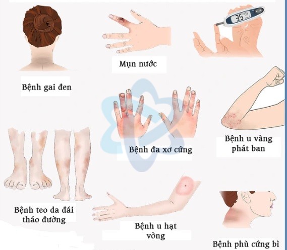 BIẾN CHỨNG DA LIỄU THƯỜNG GẶP Ở BỆNH NHÂN TIỂU ĐƯỜNG
